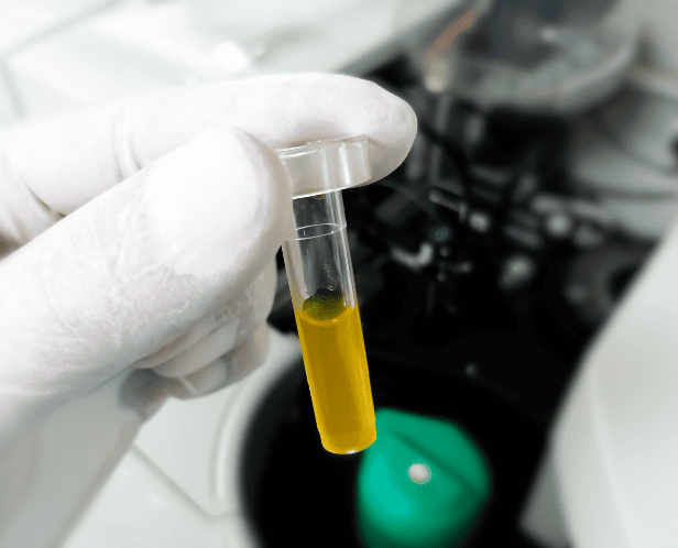 BILIRUBIN